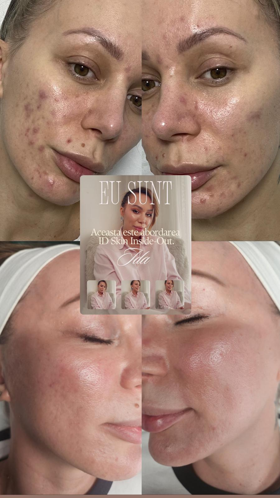 Ida — colaj înainte și după, transformarea pielii prin metoda ID Skin-InsideOut