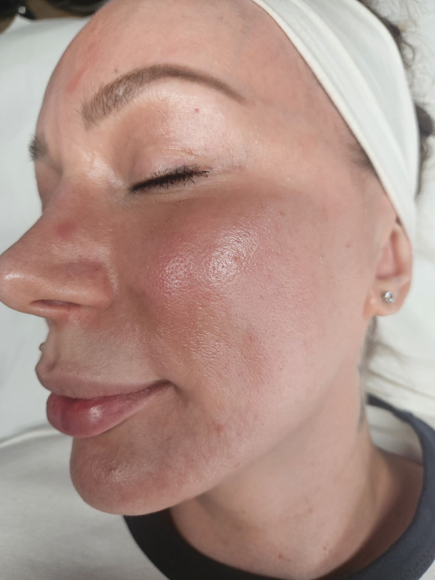 Ida — piele vindecată, după metoda ID Skin-InsideOut