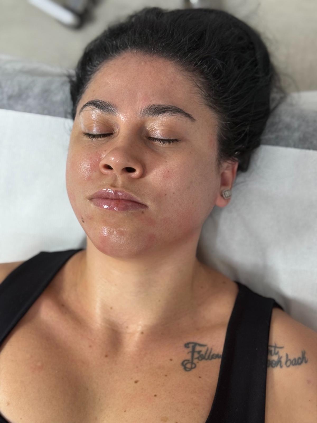 Recuperare din acnee — relaxare, piele odihnită